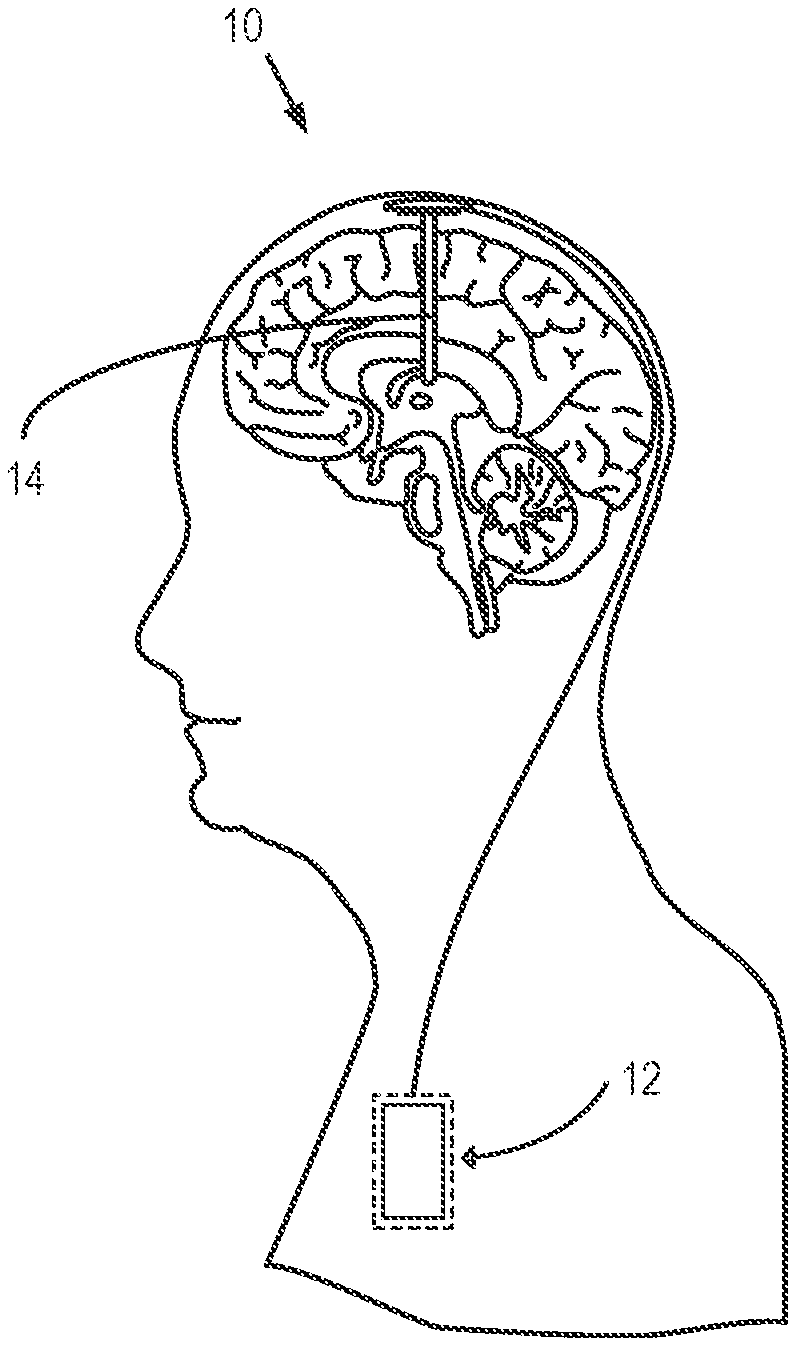 Invention for Deep Brain Stimulation System and Method with Multi-Modal, Multi-Symptom Neuromodulation